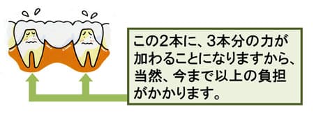 ブリッジの図