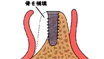 GBR法 骨補填