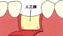 GBR法 メンブレン