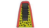 スプリットクレスト インプラント設置