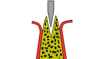 スプリットクレスト 骨分割