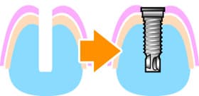 インプラントの埋入手術