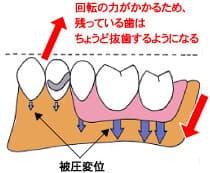部分入れ歯の図