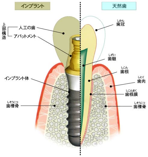 インプラントの構造